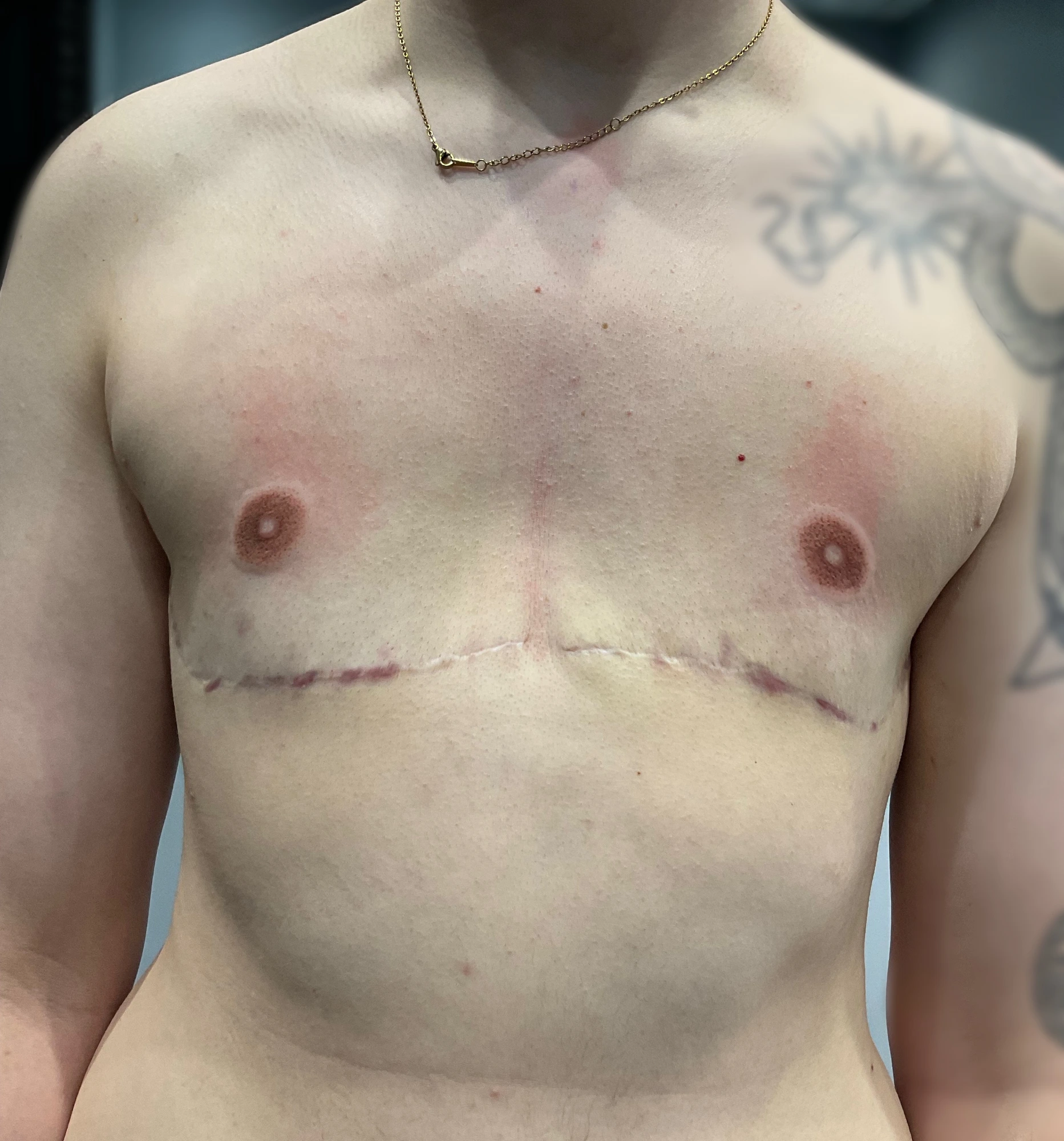 Immediately Post-Procedure — First Layer of Pigment. This image shows the areola complexes immediately following the initial pigment application. At this stage, the color may appear stronger, warmer, or more defined than the anticipated healed result. The first session establishes the foundation; the skin must now be allowed to heal and reveal how it accepts and retains the implanted pigment. The client returns in approximately three weeks for reassessment.
