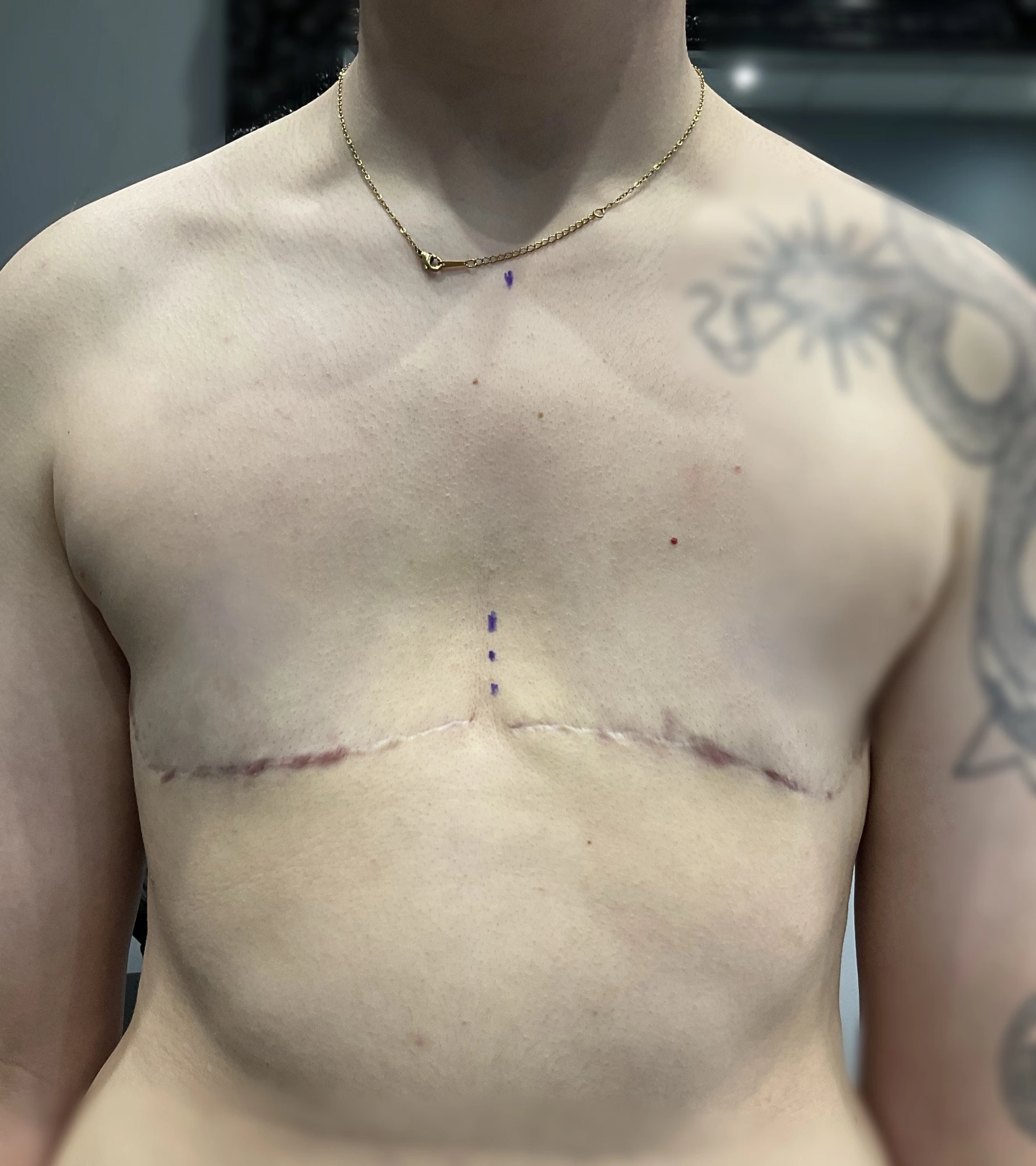 Before Procedure — Starting Point. The client has undergone gender-affirming top chest surgery and is now ready for the next stage of their restorative journey. This image documents the chest before paramedical micropigmentation and provides an important baseline for evaluating anatomy, scar placement, skin condition, symmetry, and the available tissue.
