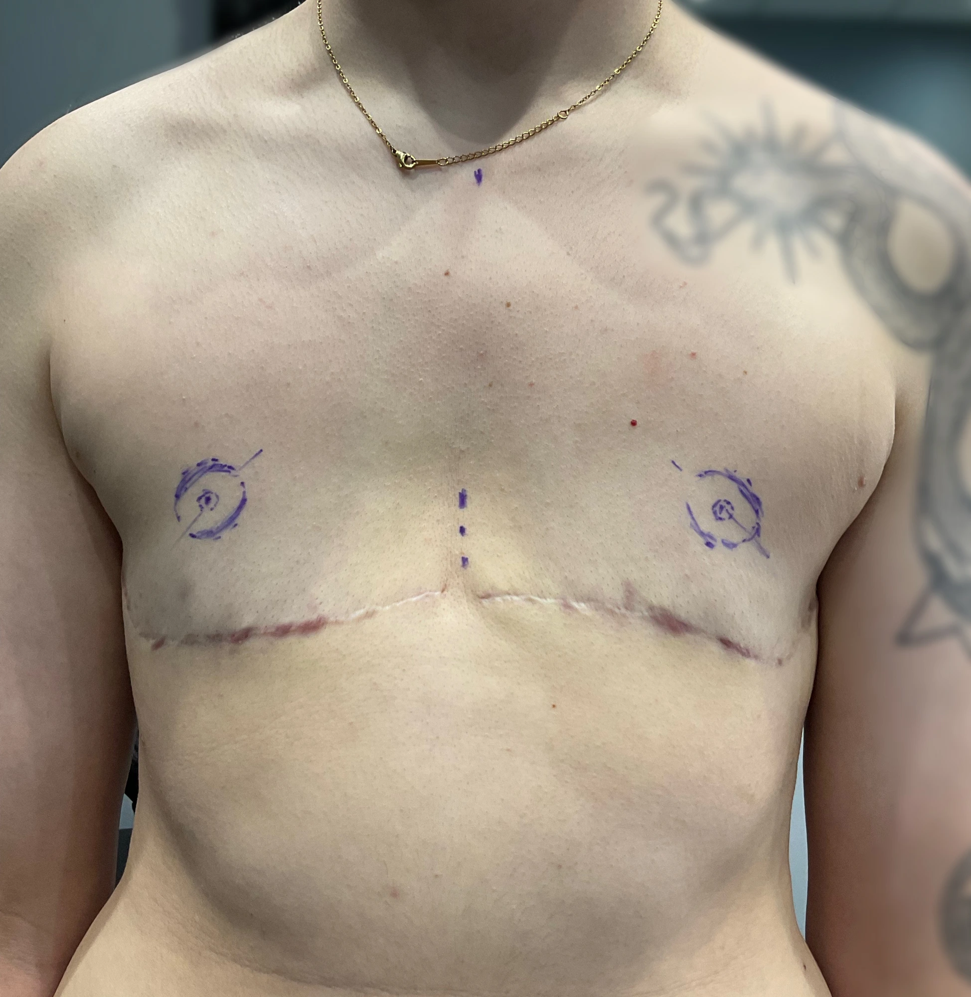 Mapping & Placement — Designing the Areola-Nipple Complex. Precision begins before pigment touches the skin. Detailed measurements and temporary surgical-style markings are used to determine the size, position, proportion, and symmetry of the new areola-nipple complexes. Placement is customized to the client's individual anatomy rather than relying on a standardized template.